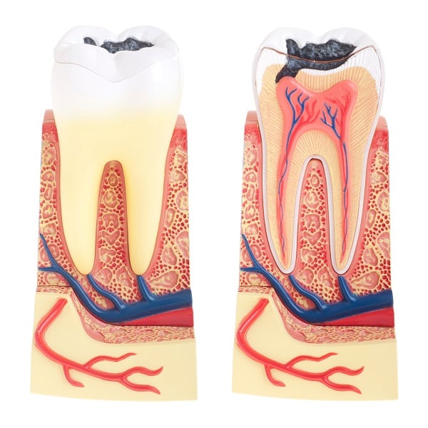 Choice Dental - Tooth Decay