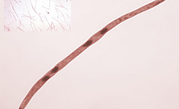 Oral bacteria linked to the development and progression of oesophageal cancer