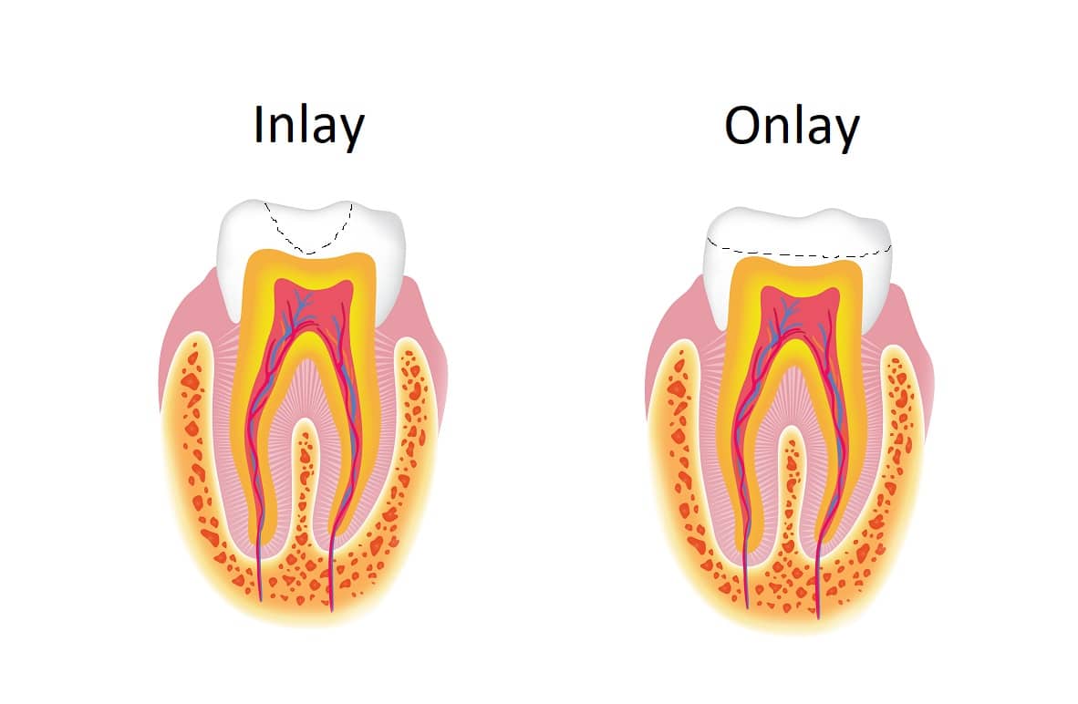 Inlays & onlays - the conservative tooth restoration