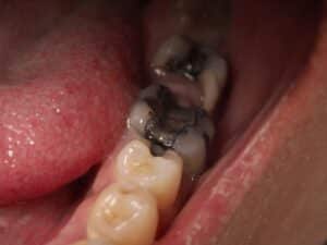 Cavities (Tooth Decay)