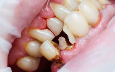 Common Dental Problems and How to Prevent Them