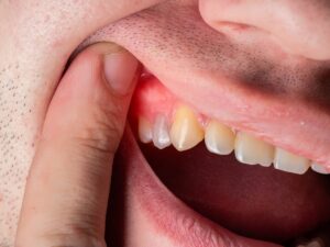 Gum Disease (Gingivitis and Periodontitis)