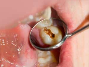 Tooth Erosion